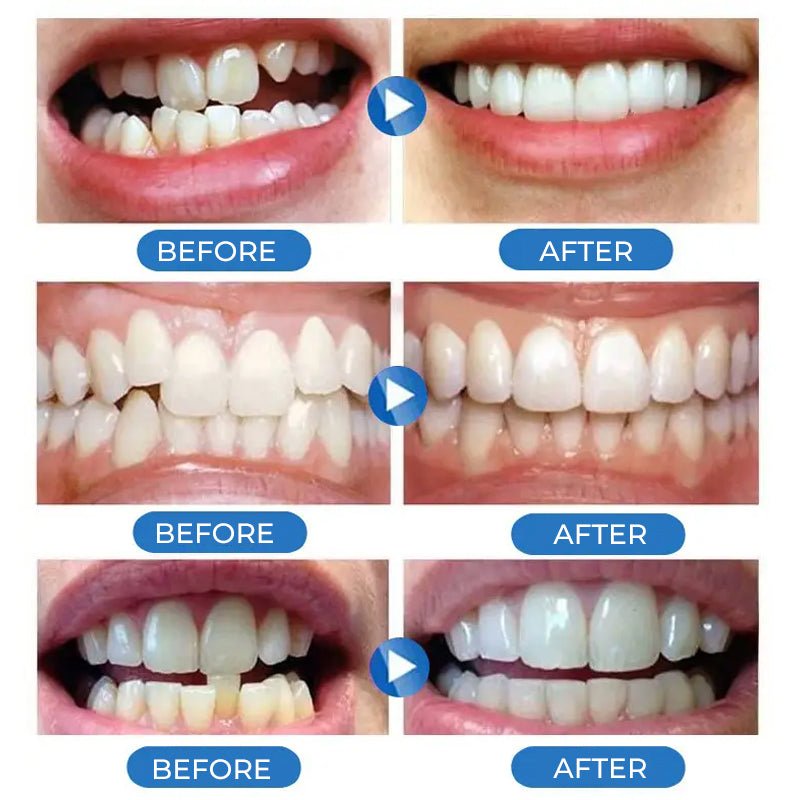 Practical Teeth Whitening Stickers Smile Veneer (Upper Teeth)