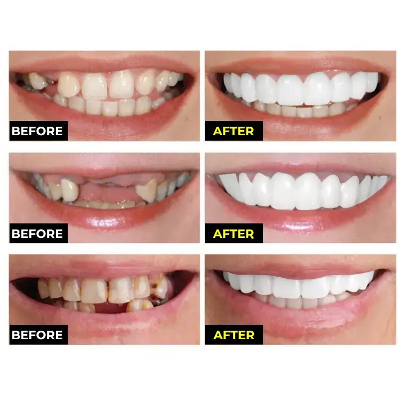 Practical Teeth Whitening Stickers Smile Veneer (Upper Teeth)